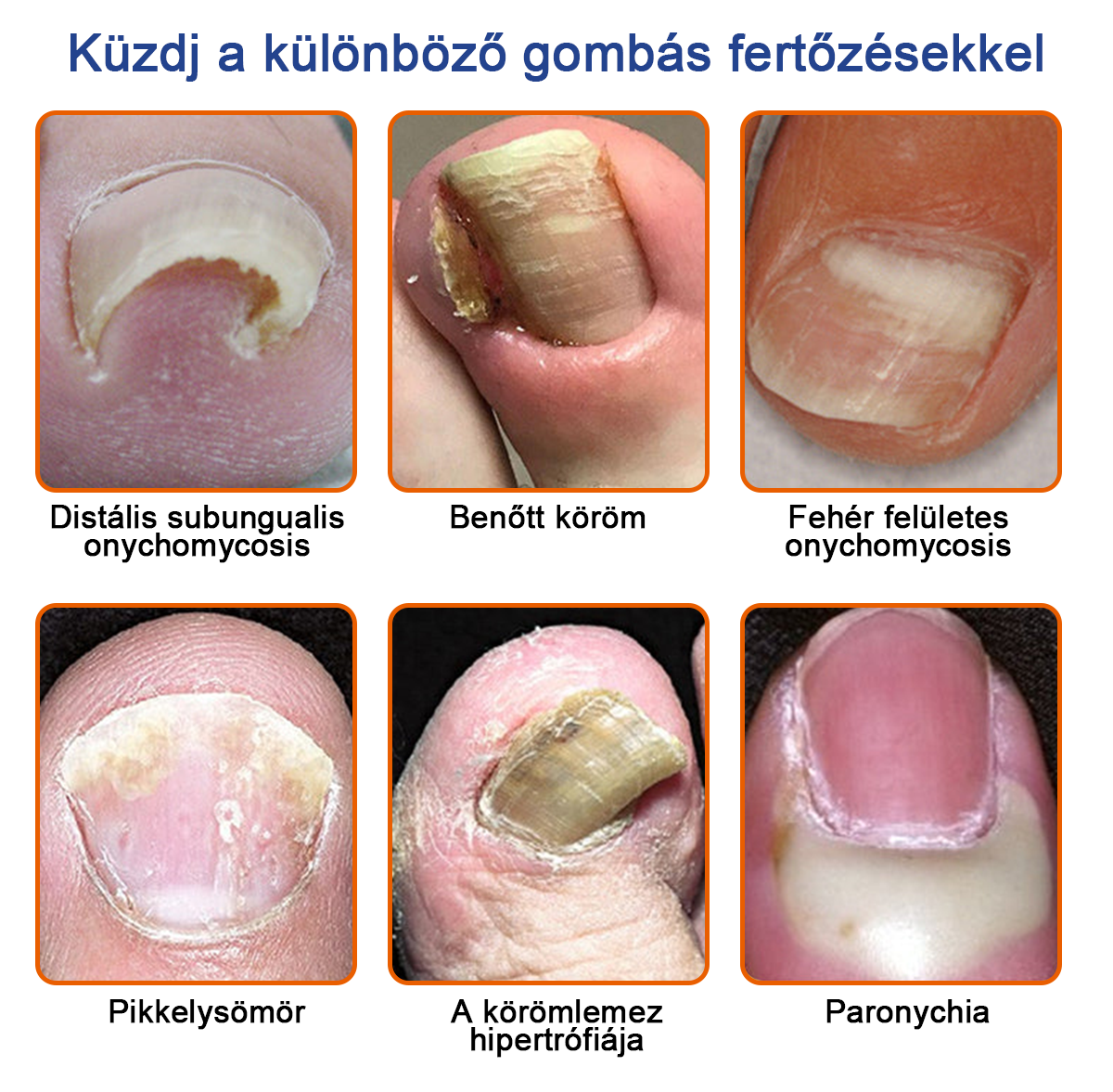 🐝Furzero™Méhméreg Körömgomba Kezelőoldat: Teljes megoldás a körömgomba problémájára🌟👣👣
