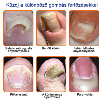 🐝Furzero™Méhméreg Körömgomba Kezelőoldat: Teljes megoldás a körömgomba problémájára🌟👣👣