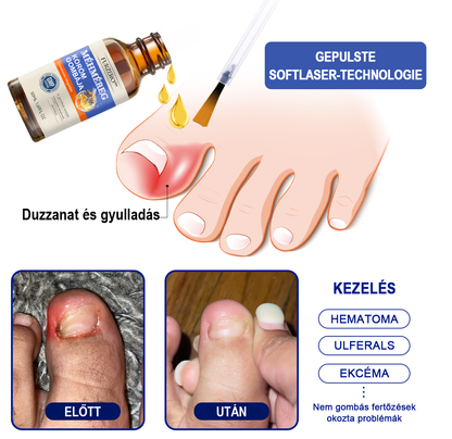 🐝Furzero™Méhméreg Körömgomba Kezelőoldat: Teljes megoldás a körömgomba problémájára🌟👣👣